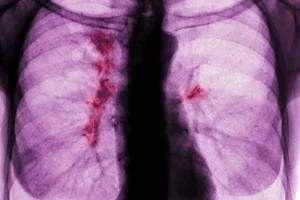 A tüdőrák egy aljas, sunyi betegség, és nincs rá állami szűrőprogramunk sem