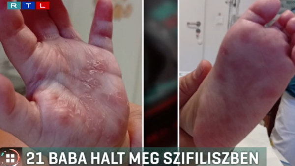 Sokkoló: idén már 21 magyar csecsemő halt meg szifilisz miatt