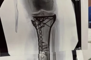 Lindsey Vonn kiposztolta, mennyi csavar és lemez kerül a sípcsontjába