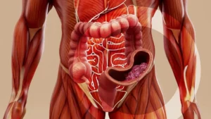 Vastagbélrák: a csendes gyilkos, ami már a 30-asokat sem kíméli