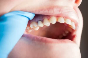 Egy ínybetegséget okozó baktérium segítheti a mellrák kialakulását